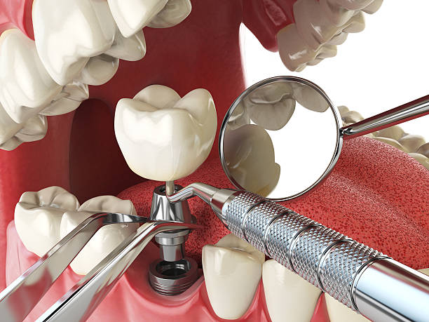 Best Knocked-Out Tooth Emergency  in Essexville, MI